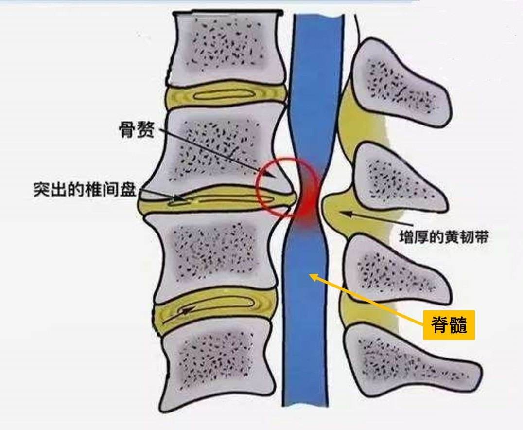 脊髓型颈椎病简介