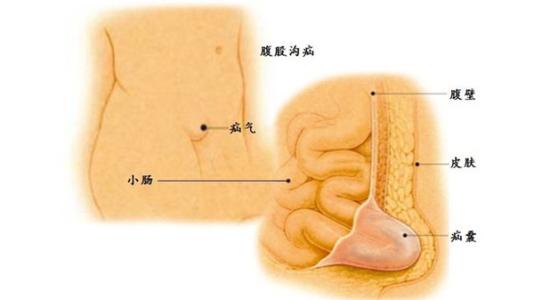 疝简介