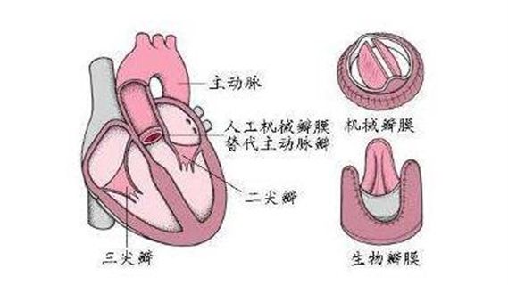 三尖瓣狭窄图片