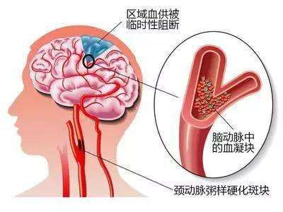 脑动脉硬化治疗方法