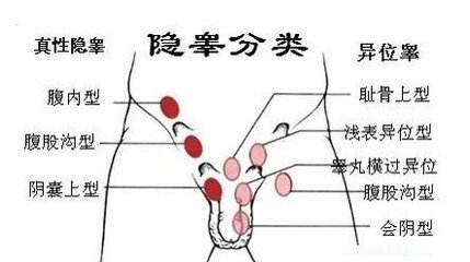 小儿隐睾症简介 指睾丸未能按照正常发育程序从腰部腹膜后下降至阴囊