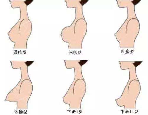 乳房整形