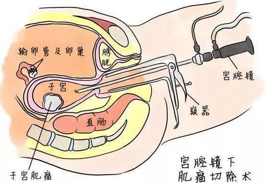 宫腔镜