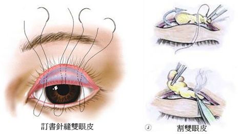 双眼皮手术